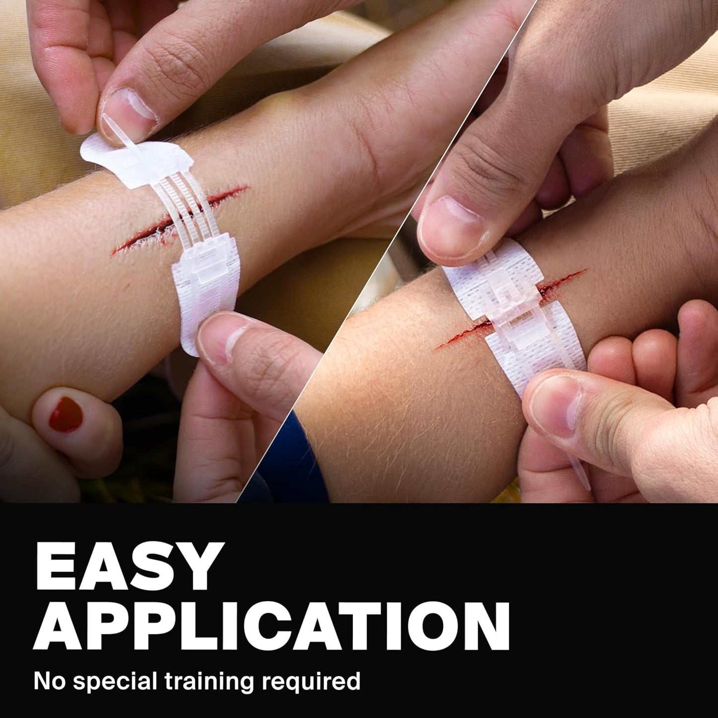 Zip Stitch Wound Closures